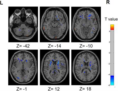 Functional activity, functional connectivity and complex network biomarkers of progressive hyposmia Parkinson’s disease with no cognitive impairment: evidences from resting-state fMRI study